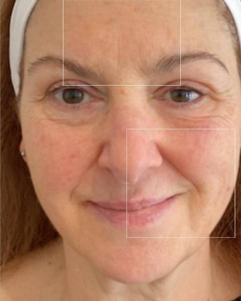 After: A smoother-looking forehead