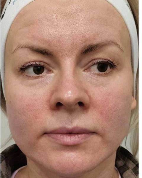 After: A more defined-looking facial oval