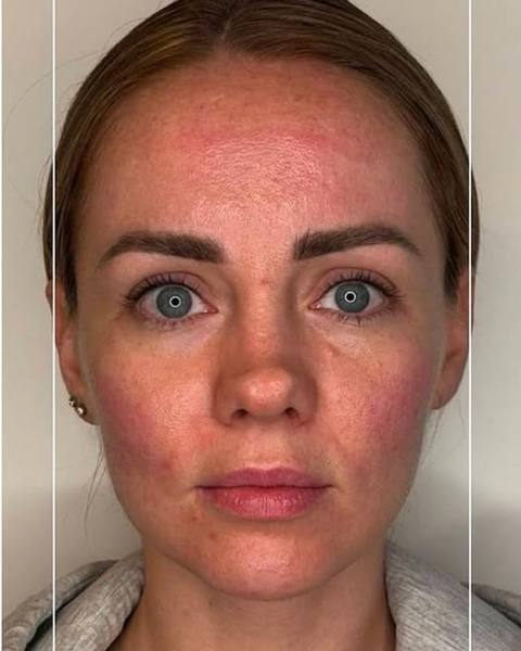 After: More lifted-looking cheekbones