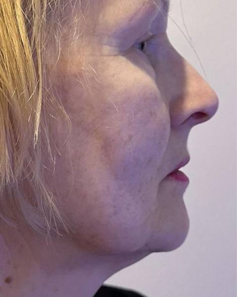 Before: A more defined-looking jawline