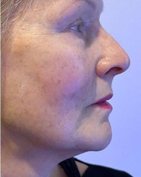 After: A more defined-looking jawline